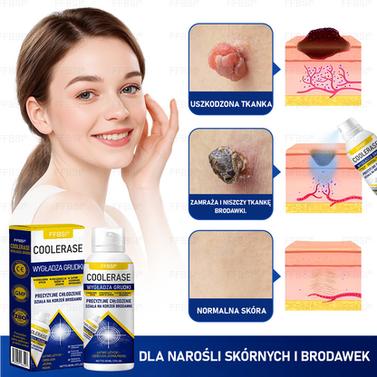 FFBSI® ❄ CoolErase Spray do regeneracji skóry  (Brodawe, Pęcherze, Wypryski, Łuszczyca, Zmiany skórne, Trądzik, Skórne narośle, Blizny, Pieprzyki)