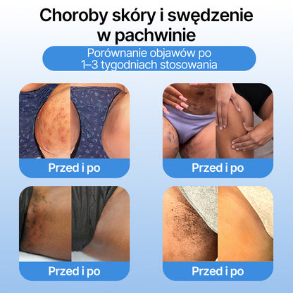 FFBSI® ❄ CoolErase Spray do regeneracji skóry  (Brodawe, Pęcherze, Wypryski, Łuszczyca, Zmiany skórne, Trądzik, Skórne narośle, Blizny, Pieprzyki)