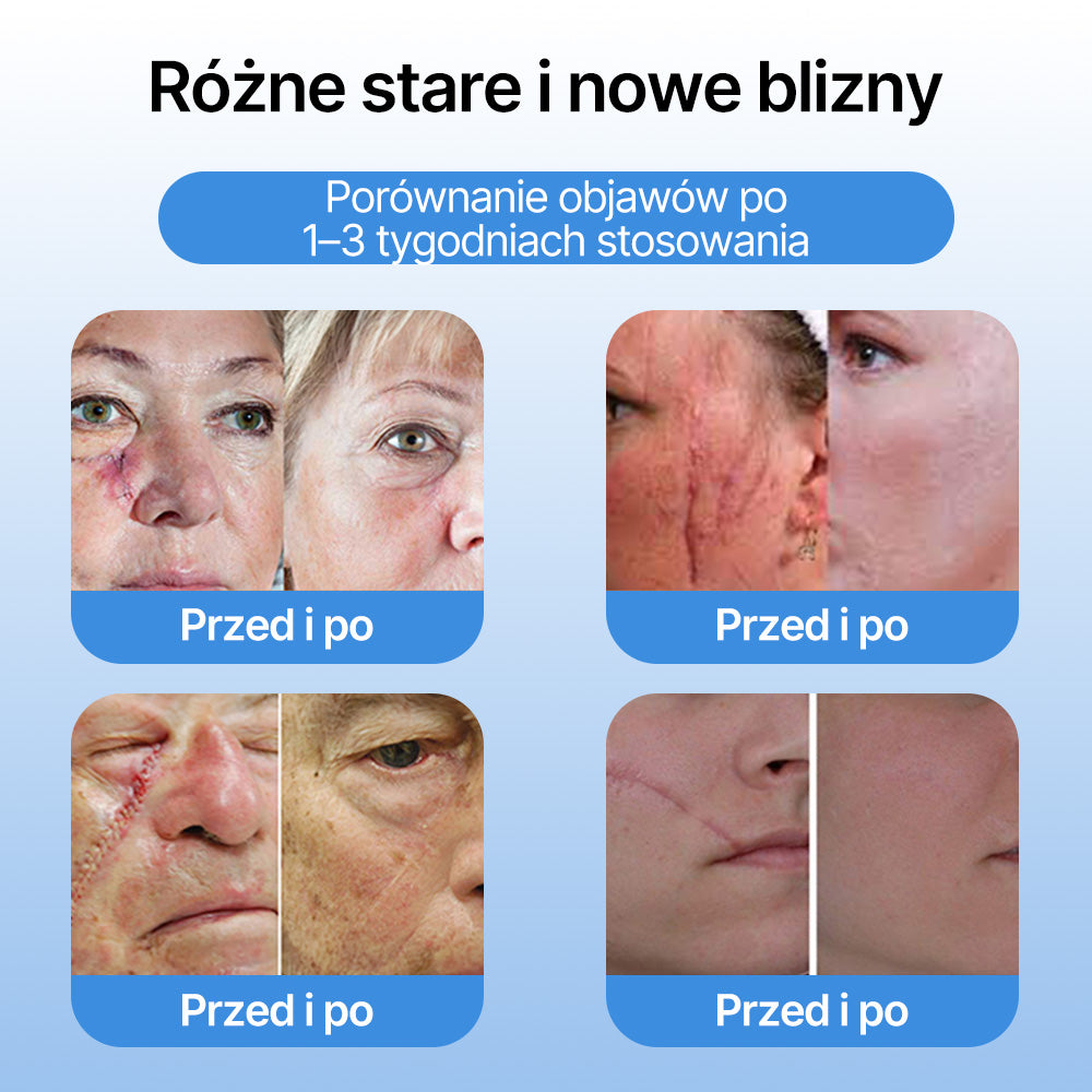 FFBSI® ❄ CoolErase Spray do regeneracji skóry  (Brodawe, Pęcherze, Wypryski, Łuszczyca, Zmiany skórne, Trądzik, Skórne narośle, Blizny, Pieprzyki)