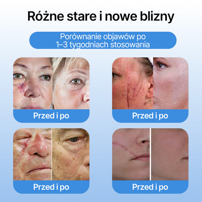 FFBSI® ❄ CoolErase Spray do regeneracji skóry  (Brodawe, Pęcherze, Wypryski, Łuszczyca, Zmiany skórne, Trądzik, Skórne narośle, Blizny, Pieprzyki)