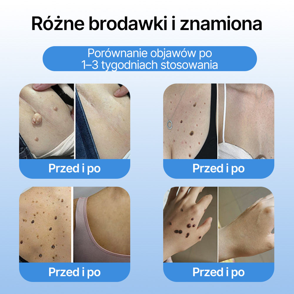 FFBSI® ❄ CoolErase Spray do regeneracji skóry  (Brodawe, Pęcherze, Wypryski, Łuszczyca, Zmiany skórne, Trądzik, Skórne narośle, Blizny, Pieprzyki)
