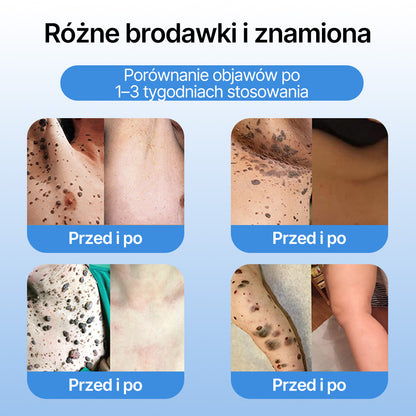 FFBSI® ❄ CoolErase Spray do regeneracji skóry  (Brodawe, Pęcherze, Wypryski, Łuszczyca, Zmiany skórne, Trądzik, Skórne narośle, Blizny, Pieprzyki)