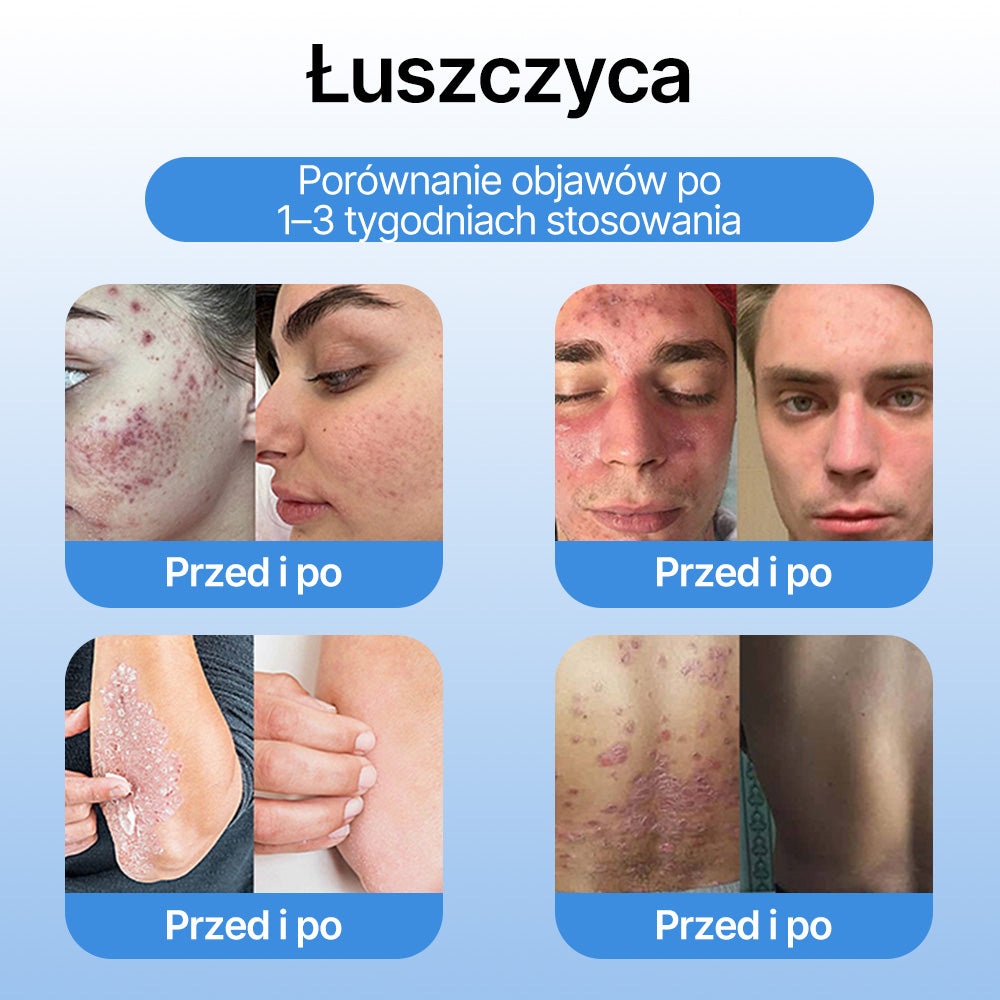 FFBSI® ❄ CoolErase Spray do regeneracji skóry  (Brodawe, Pęcherze, Wypryski, Łuszczyca, Zmiany skórne, Trądzik, Skórne narośle, Blizny, Pieprzyki)