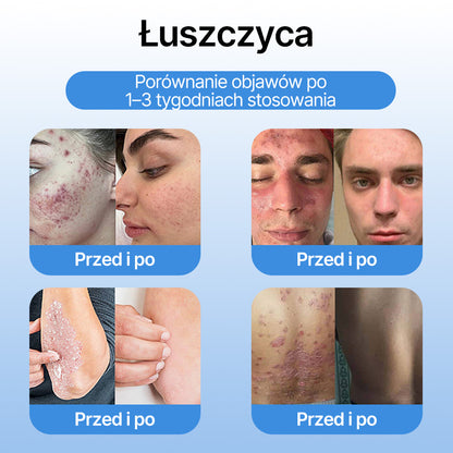 FFBSI® ❄ CoolErase Spray do regeneracji skóry  (Brodawe, Pęcherze, Wypryski, Łuszczyca, Zmiany skórne, Trądzik, Skórne narośle, Blizny, Pieprzyki)
