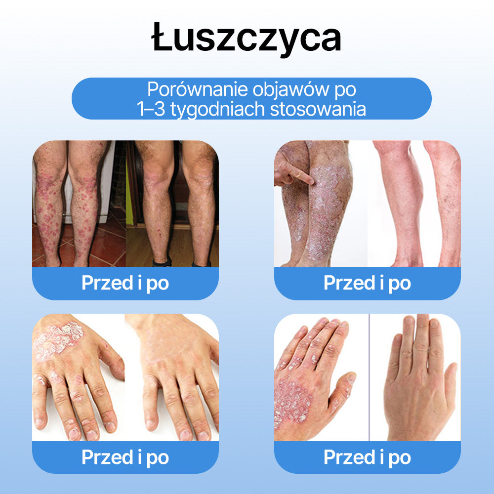 FFBSI® ❄ CoolErase Spray do regeneracji skóry  (Brodawe, Pęcherze, Wypryski, Łuszczyca, Zmiany skórne, Trądzik, Skórne narośle, Blizny, Pieprzyki)