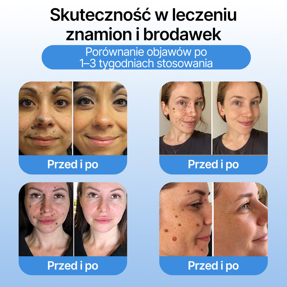FFBSI® ❄ CoolErase Spray do regeneracji skóry  (Brodawe, Pęcherze, Wypryski, Łuszczyca, Zmiany skórne, Trądzik, Skórne narośle, Blizny, Pieprzyki)