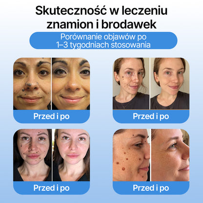 FFBSI® ❄ CoolErase Spray do regeneracji skóry  (Brodawe, Pęcherze, Wypryski, Łuszczyca, Zmiany skórne, Trądzik, Skórne narośle, Blizny, Pieprzyki)