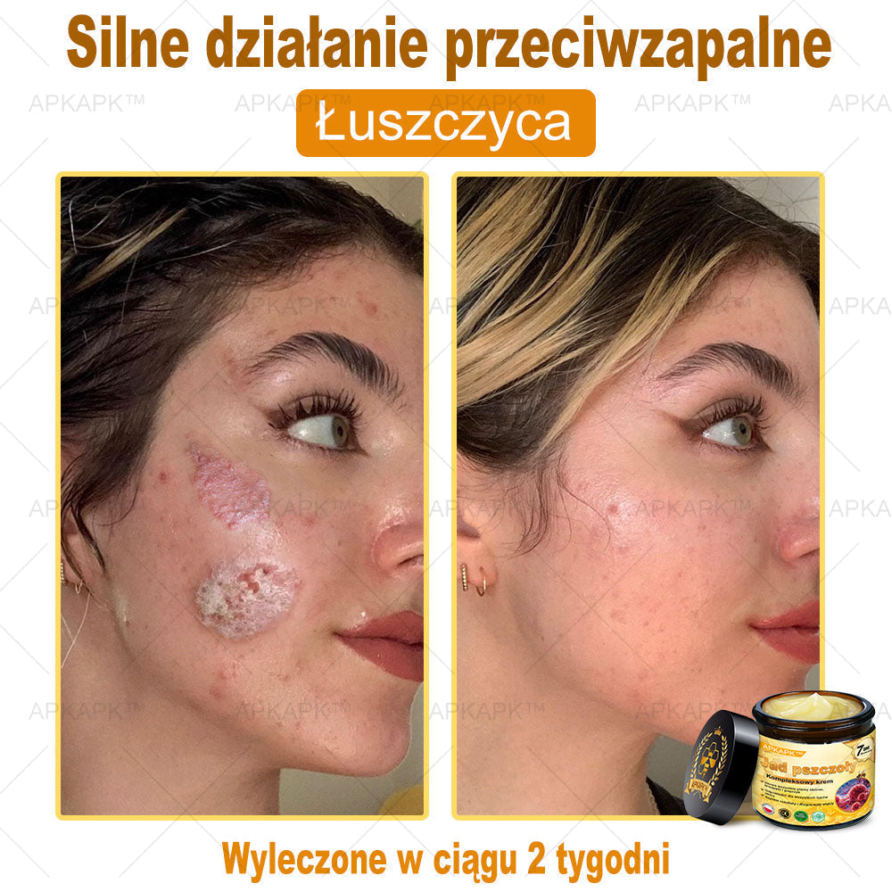 𝖠𝖯𝖪𝖠𝖯𝖪® 🐝𝗕𝗲𝗲 𝗩𝗲𝗻𝗼𝗺 𝗞𝗿𝗲𝗺 𝗻𝗮 𝗼𝗯𝗻𝗼𝘄𝗲𝗻𝗶𝗲 𝗸𝗼𝘇𝗵𝘆🐝pomaga w leczeniu problemów skórnych, takich jak: zmarszczki, blizny, plamy pigmentacyjne, rozstępy, trądzik, łuszczyca, egzema, zmiany skórne, podrażnienia, stany zapalne i inne problemy skórne