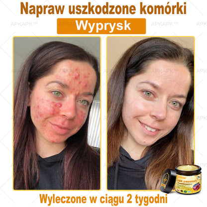 𝖠𝖯𝖪𝖠𝖯𝖪® 🐝𝗕𝗲𝗲 𝗩𝗲𝗻𝗼𝗺 𝗞𝗿𝗲𝗺 𝗻𝗮 𝗼𝗯𝗻𝗼𝘄𝗲𝗻𝗶𝗲 𝗸𝗼𝘇𝗵𝘆🐝pomaga w leczeniu problemów skórnych, takich jak: zmarszczki, blizny, plamy pigmentacyjne, rozstępy, trądzik, łuszczyca, egzema, zmiany skórne, podrażnienia, stany zapalne i inne problemy skórne