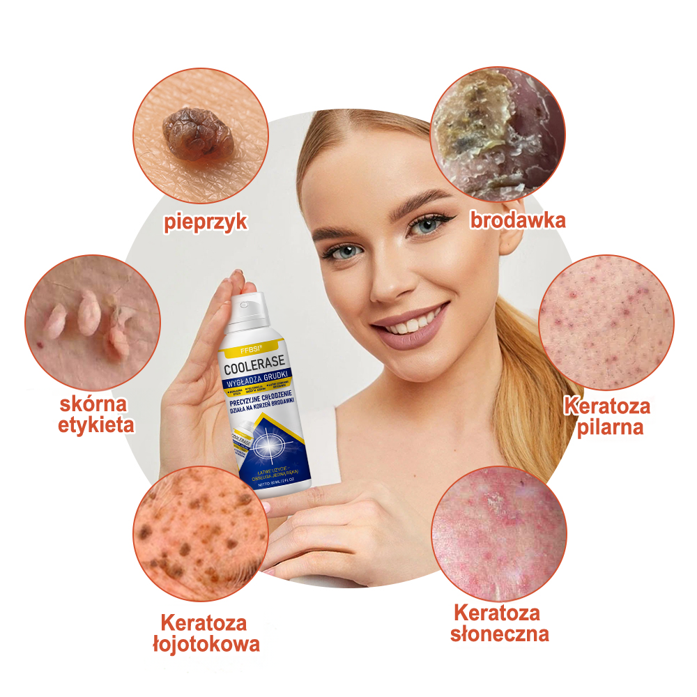 FFBSI® ❄ CoolErase Spray do regeneracji skóry  (Brodawe, Pęcherze, Wypryski, Łuszczyca, Zmiany skórne, Trądzik, Skórne narośle, Blizny, Pieprzyki)