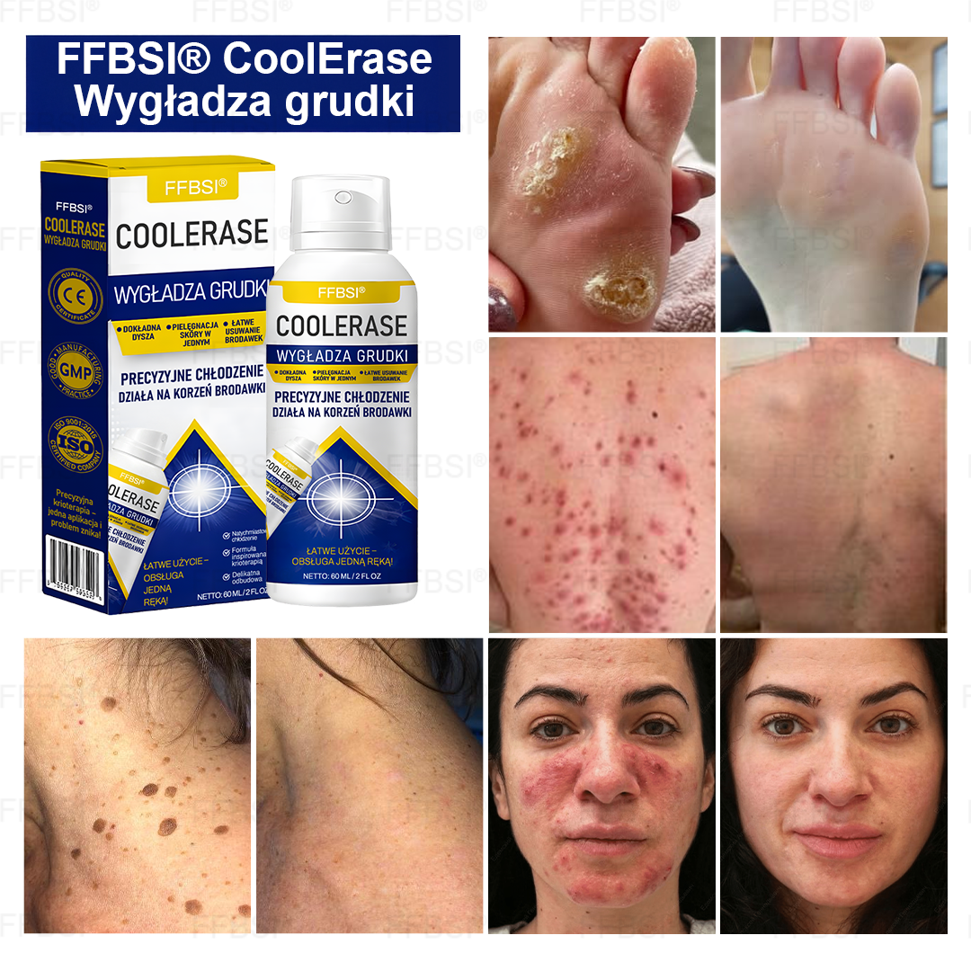 FFBSI® 🍀 CoolErase Spray do regeneracji skóry  (Brodawe, Pęcherze, Wypryski, Łuszczyca, Zmiany skórne, Trądzik, Skórne narośle, Blizny, Pieprzyki)