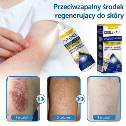 FFBSI® 🍀 CoolErase Spray do regeneracji skóry  (Brodawe, Pęcherze, Wypryski, Łuszczyca, Zmiany skórne, Trądzik, Skórne narośle, Blizny, Pieprzyki)
